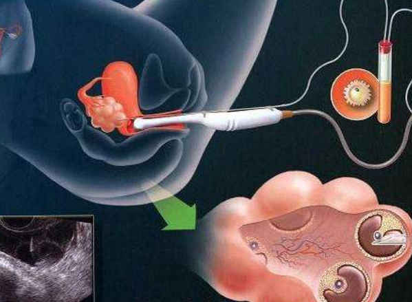 借卵做试管婴儿需不需要输卵管