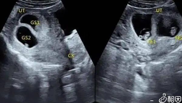 3代供卵试管婴儿养囊