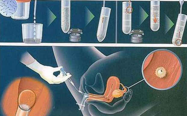 睾丸穿刺都是死精子能不能治疗